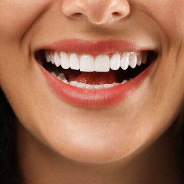Sorriso branco no verão: 5 mitos e verdades sobre clareamento dental