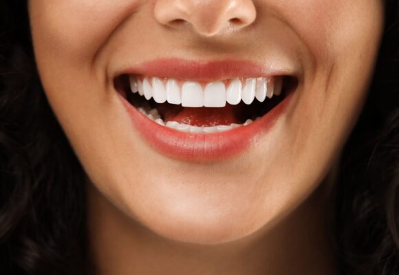 Sorriso branco no verão: 5 mitos e verdades sobre clareamento dental