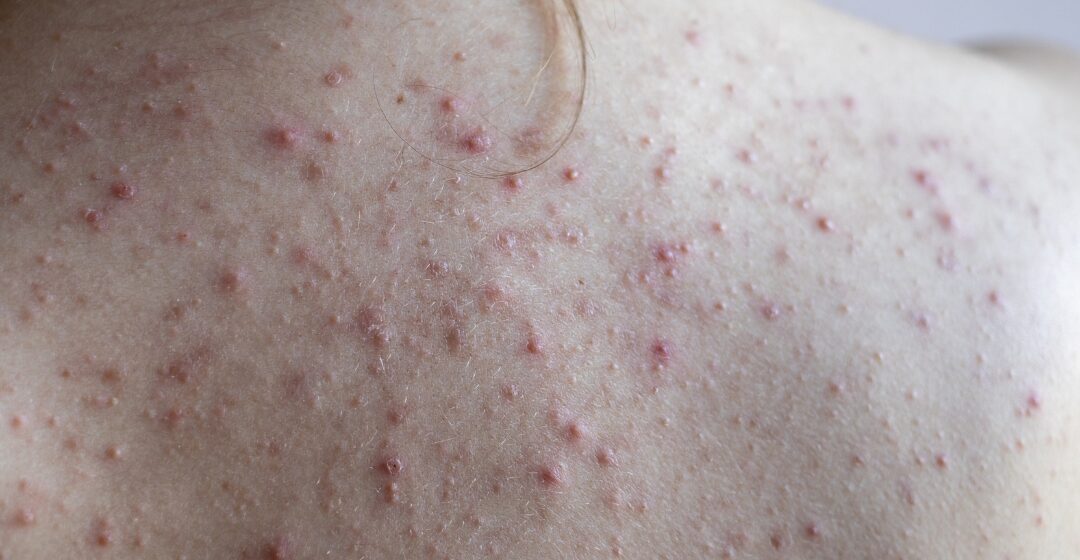 Espinhas nas costas: conheça fatores que contribuem para acnes nessa área do corpo