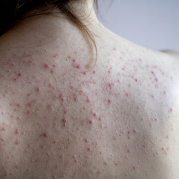 Espinhas nas costas: conheça fatores que contribuem para acnes nessa área do corpo
