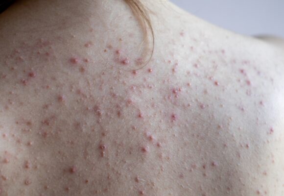 Espinhas nas costas: conheça fatores que contribuem para acnes nessa área do corpo